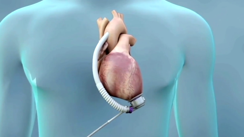 تعبیه قلب مصنوعی در بدن یک بیمار به همت خیرین برای اولین بار در کشور
