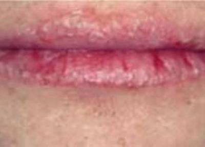 حساسیت به رژ لب و پوسته ریزی لب ها