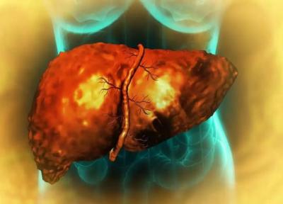 دارویی که از حنا به دست آمده، شاید بتواند روند فیبروز کبد را مهار و حتی معکوس کند!